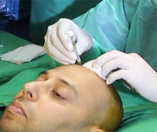Illustration for article titled Hair Transplant in Rawalpindi/Islamabad